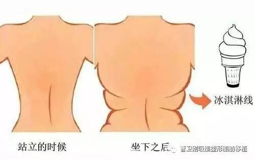 冰淇淋线就是脂肪线,教你快速消除脂肪线