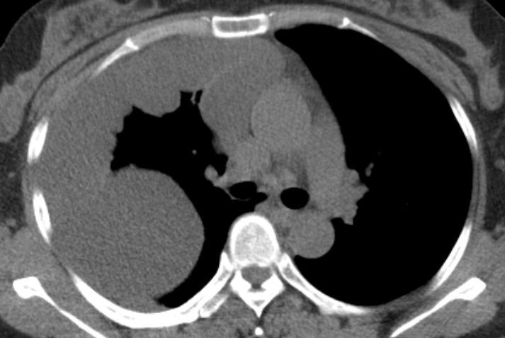 遇到恶性胸膜间皮瘤莫慌张