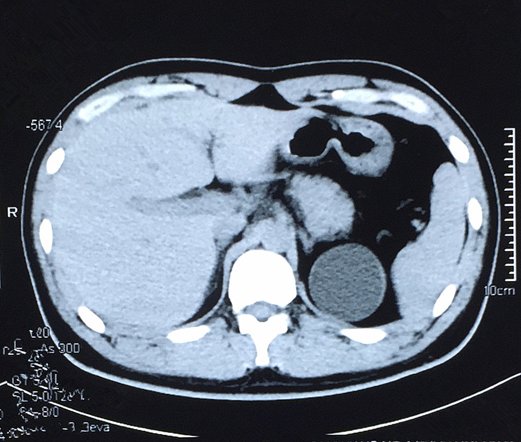 男性,25岁,单位体检时发现左肾囊肿,ct显示左肾上极可见一约6
