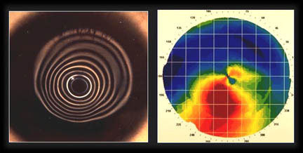 角膜地形图检查:角膜中央地形图畸变,颞下象限角膜变陡峭.示意图.