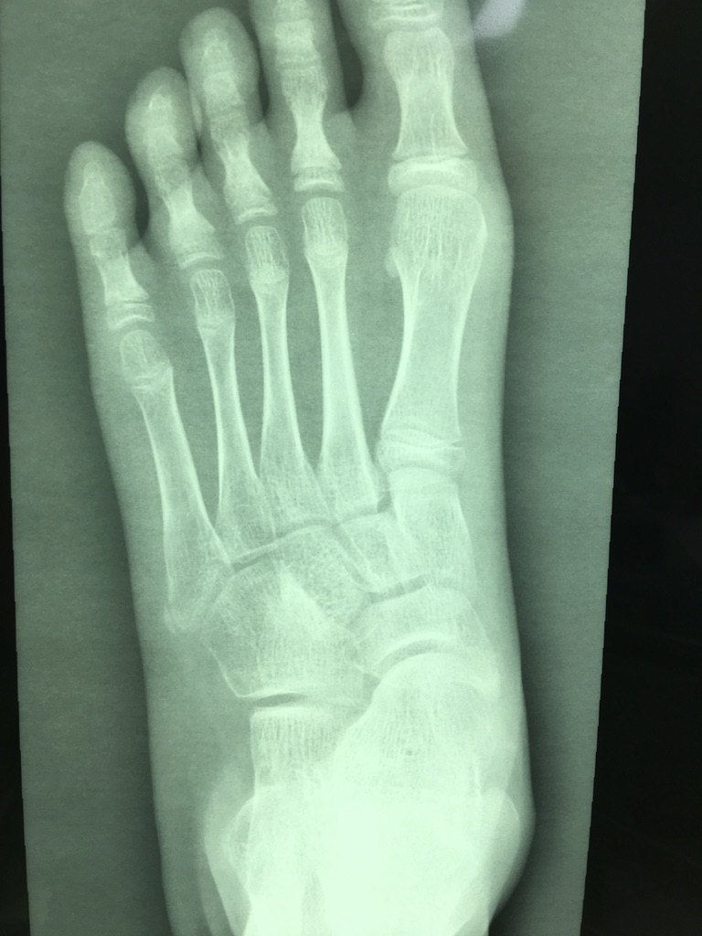 儿童足部x线骨骺图图片