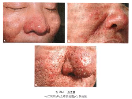 酒渣鼻玫瑰痤疮你的面子在哪里 好大夫在线 酒渣鼻玫瑰痤疮你的面子在哪里 好大夫在线