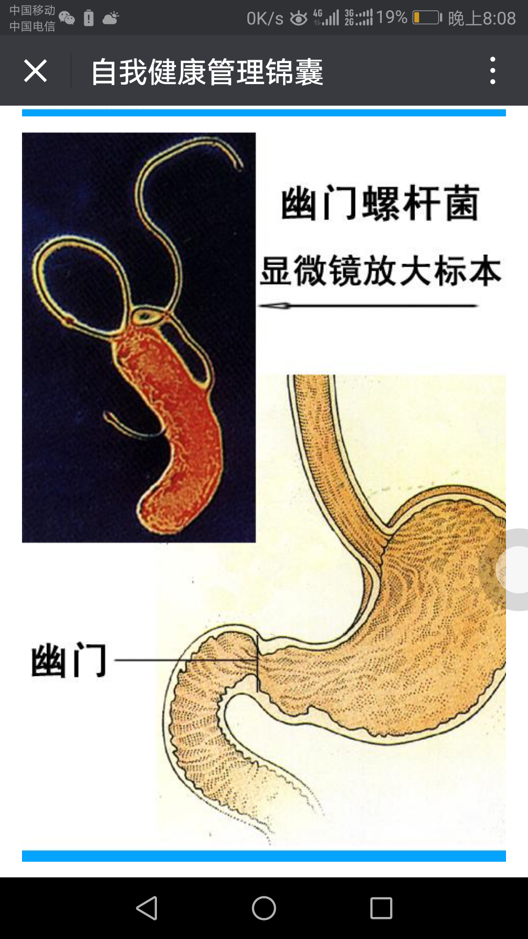 预防,治疗胃幽门螺杆菌感染是必须的 - 好大夫在线