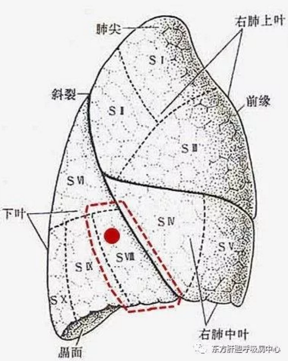 第七期体检胸部ct发现肺结节毛玻璃影怎么办