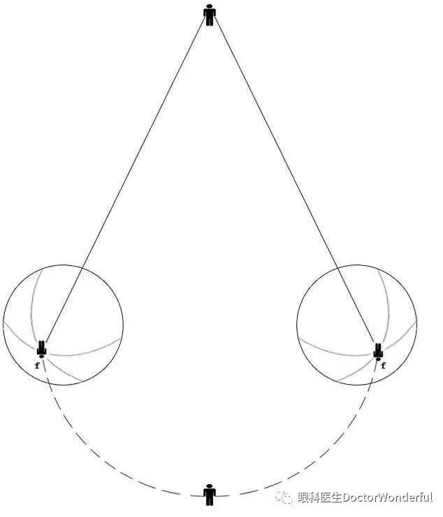 斜视的最佳治疗方式及手术时机