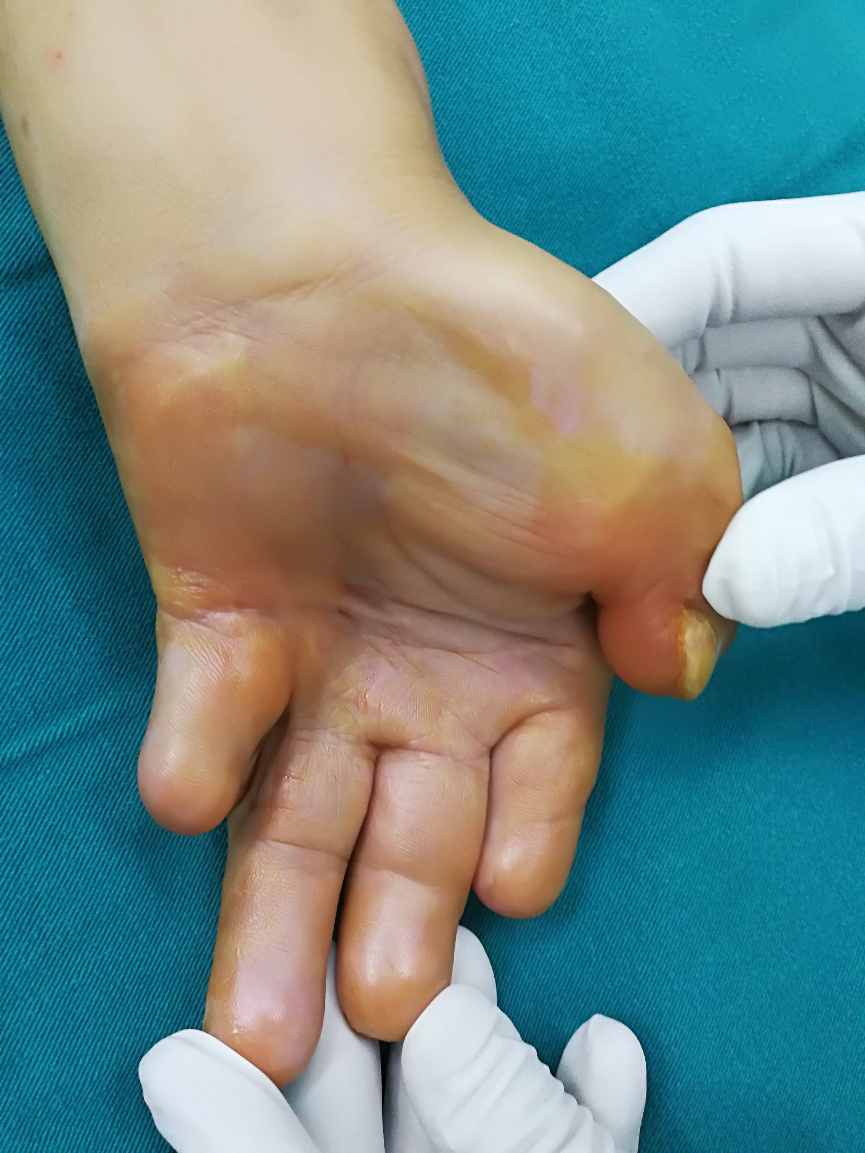 一个烧伤疤痕挛缩病例 - 好大夫在线