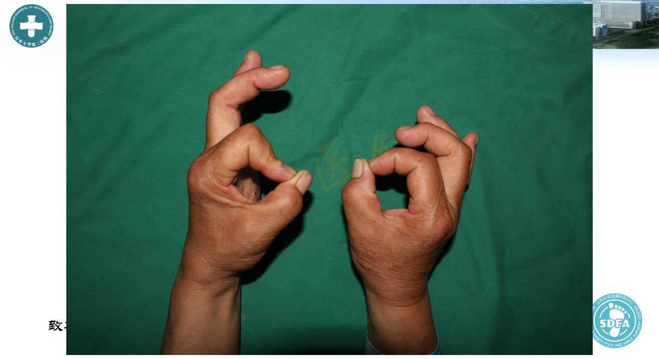 术前肌肉无力严重,forment征阳性左侧虎口肌肉萎缩术前精确制导,找出