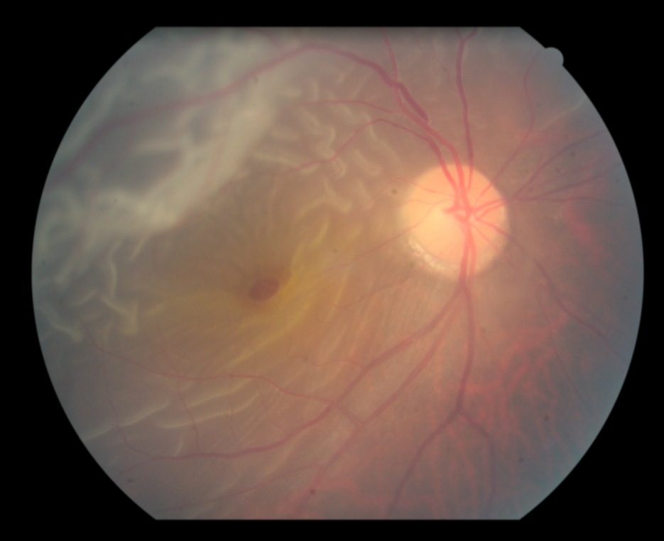 认识黄斑裂孔性视网膜脱离