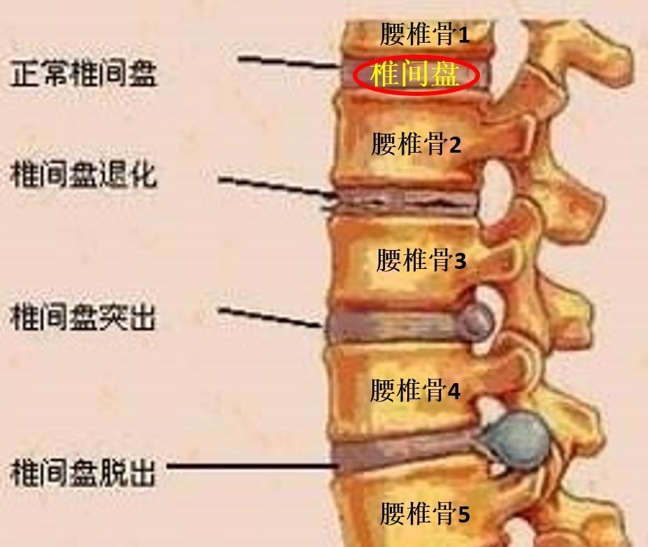 l4s1椎间盘突出位置图图片