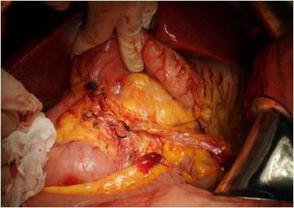结直肠癌肝转移的治愈之路—mdt(多学科协作)携手同行 - 好大夫在线