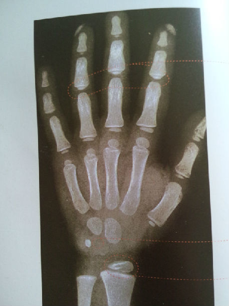 如何识别孩子的骨龄片——关注身高&警惕早熟