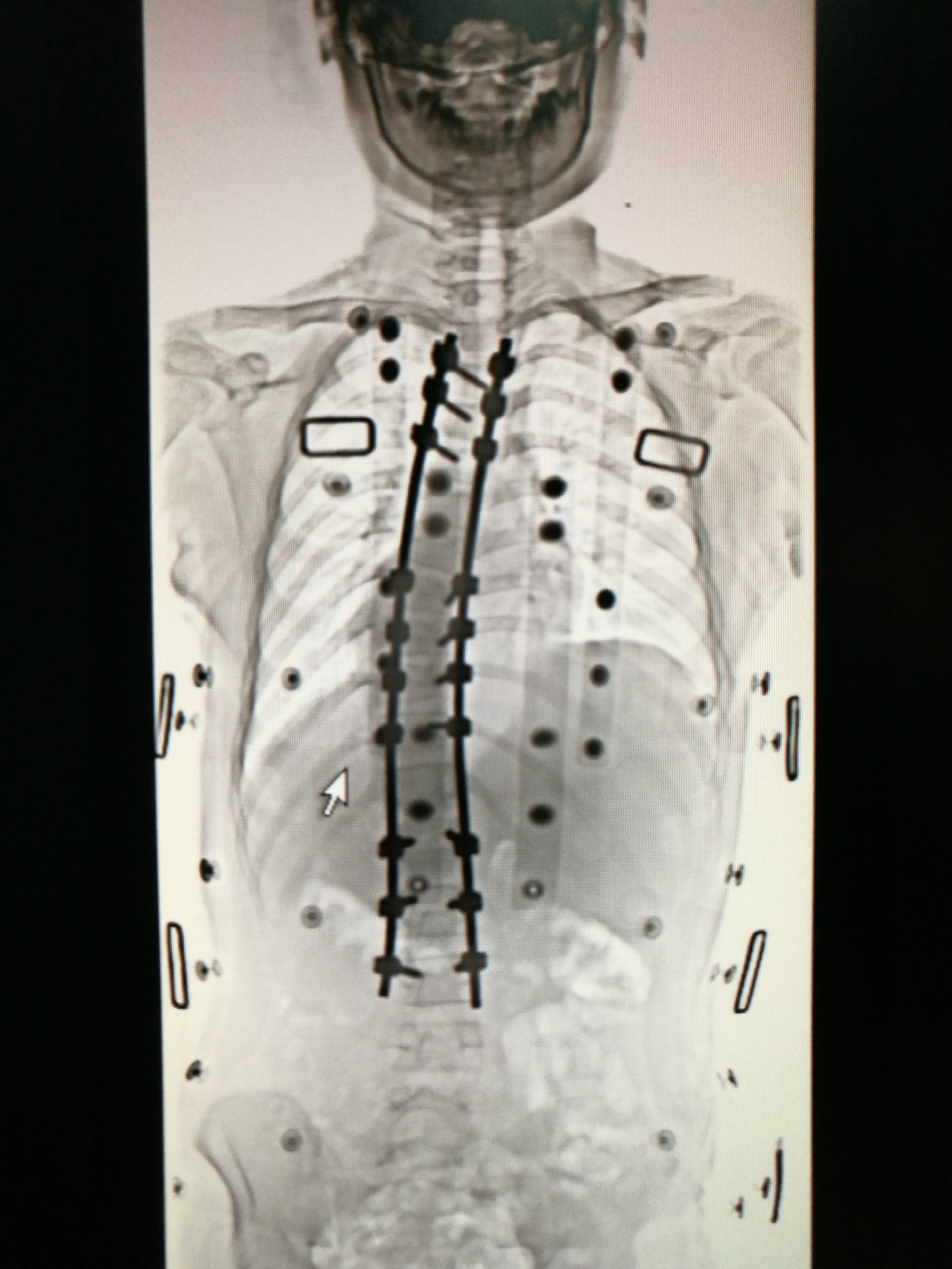 神经肌肉型脊柱侧弯畸形矫正手术一例 