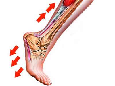 上图中白色的条索状的是肌腱和筋膜,其中位于脚底板的那一条就是跖底