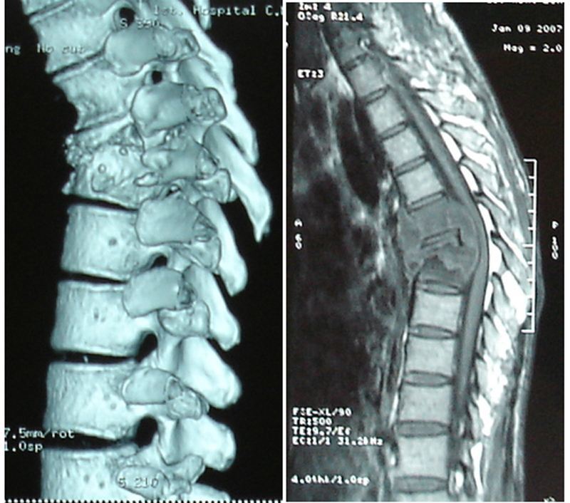 腰腿疼痛不止是腰椎间盘突出症 也可能是它 腰腿痛 腰腿痛病因