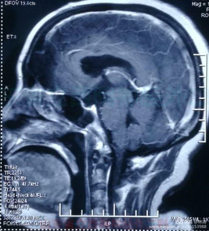 全切巨大钙化颅咽管瘤