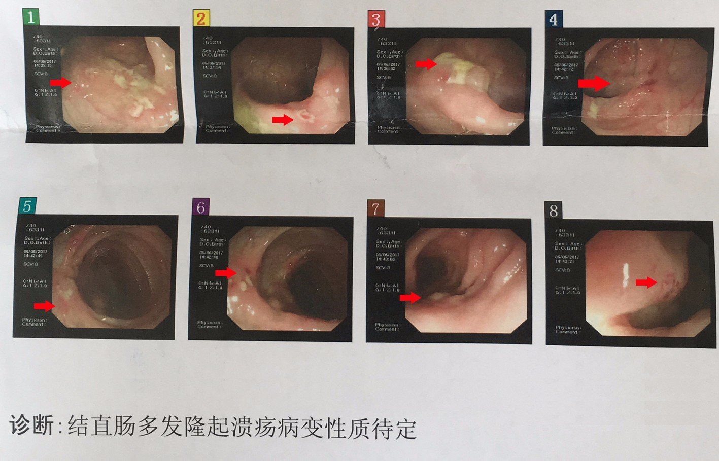 肛裂的图片 实拍图片