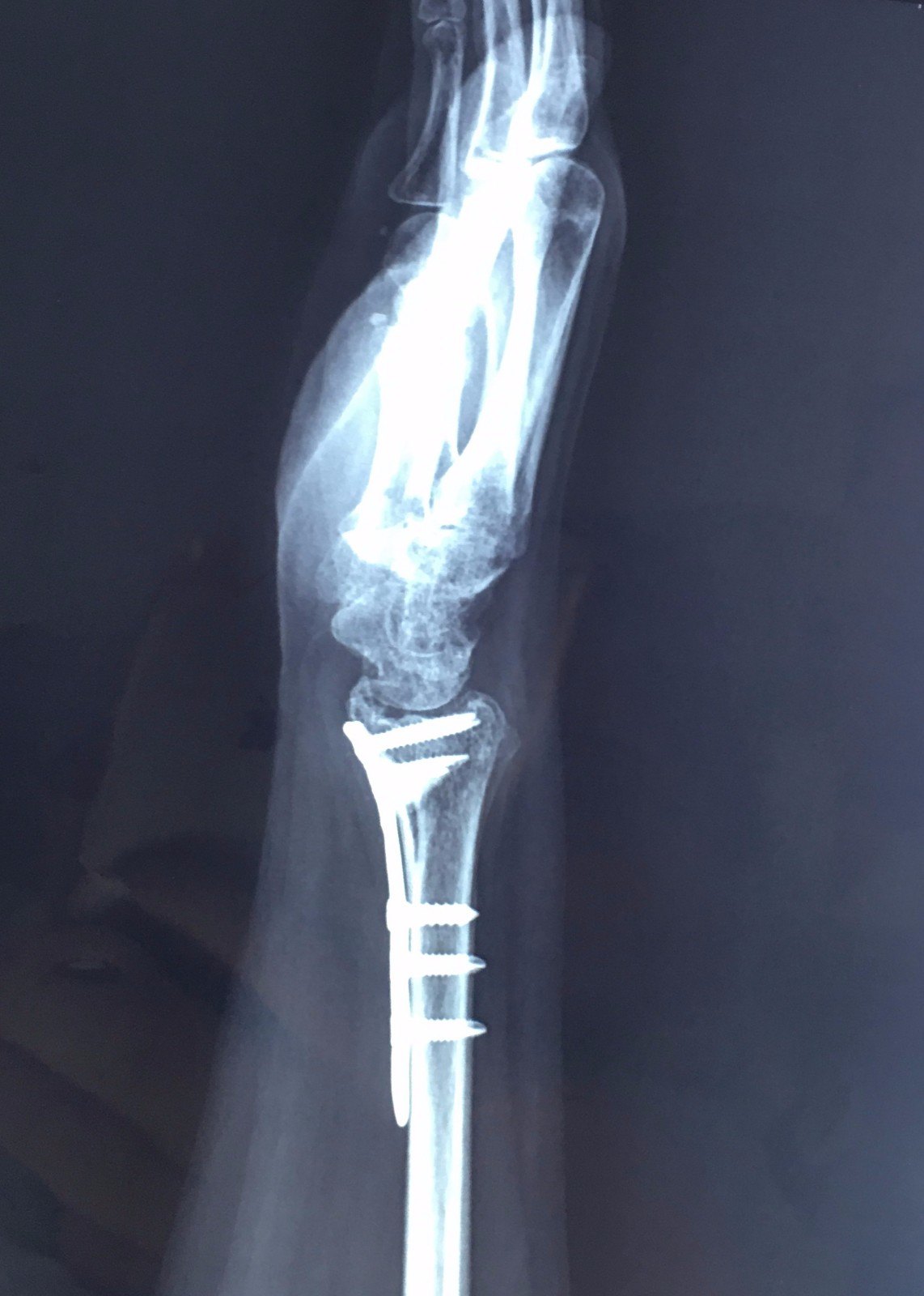手腕骨裂x光图片图片