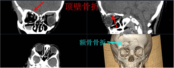 lefort骨折Ⅰ,Ⅱ,Ⅲ型常合并眼眶壁骨折:眼球凹陷,张口受限本文是邓远