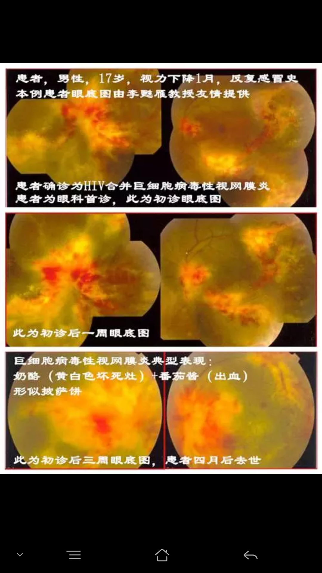 艾滋病眼部表现图片图片