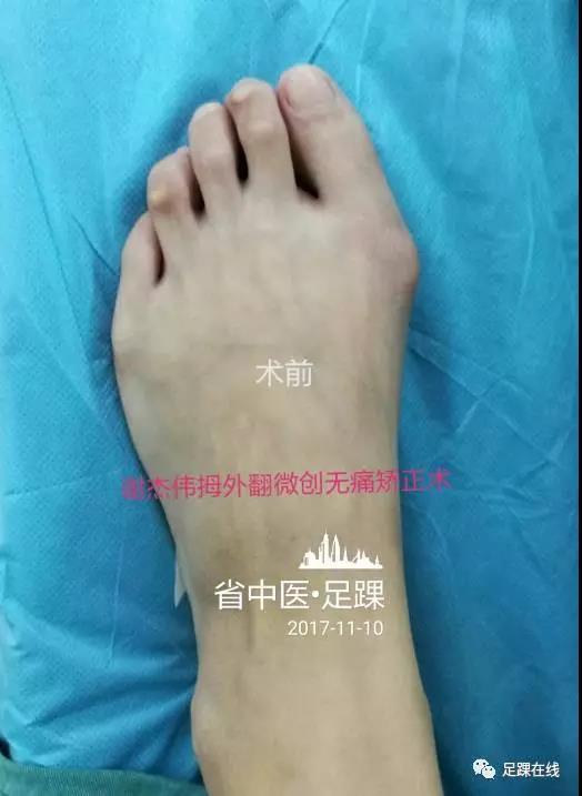 拇外翻俗稱大腳骨的微創無痛美容矯正術