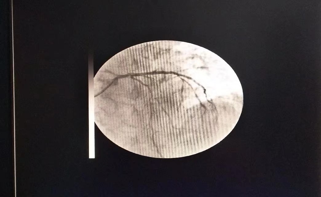 心脏回旋支无法放支架图片