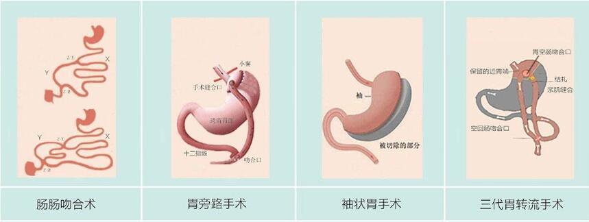 減重手術怎麼選擇術式?應該做哪一種減重手術?