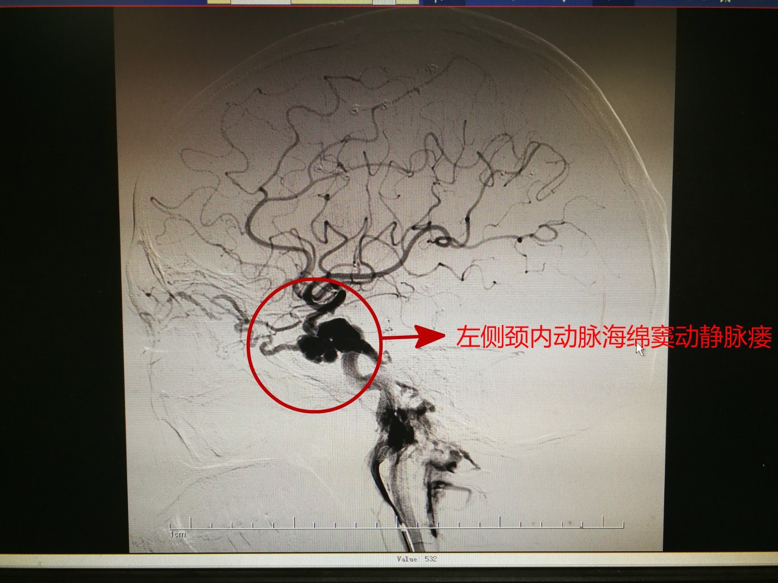 確診為左側頸內動脈海綿竇瘻.