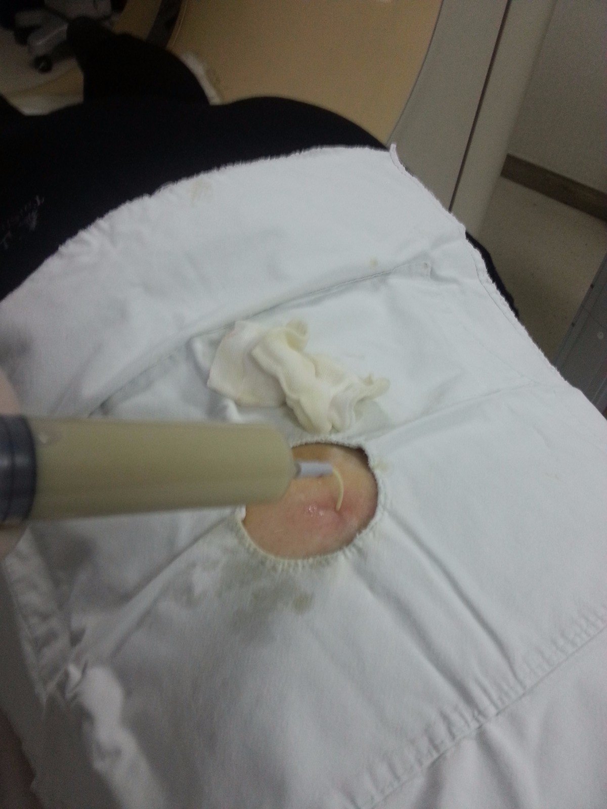 肾脓肿ct引导下经皮穿刺抽吸治疗 (原创)