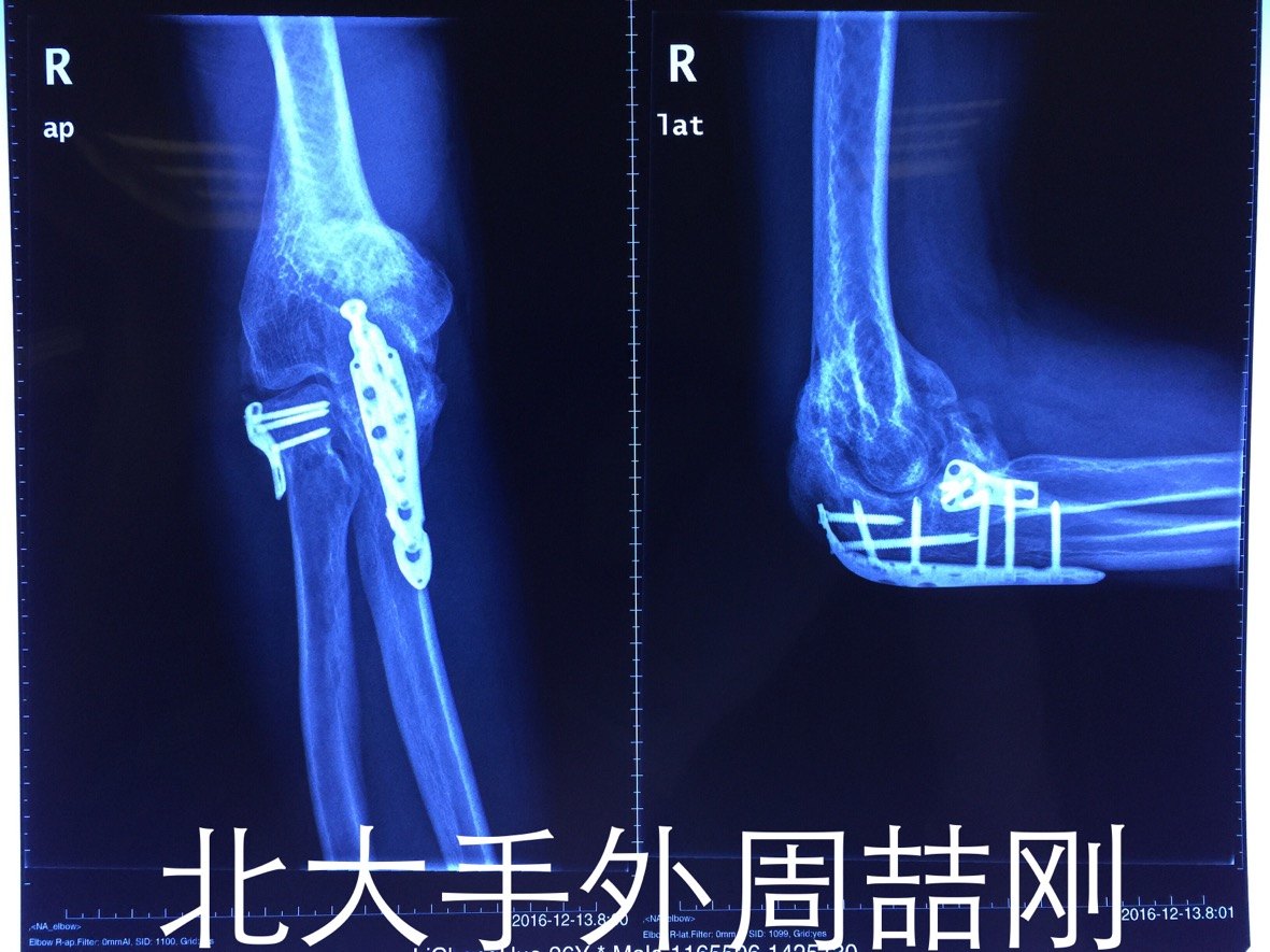 患者一年前于外院行肘部骨折内固定术 术后出现异位骨化及肘关节僵硬