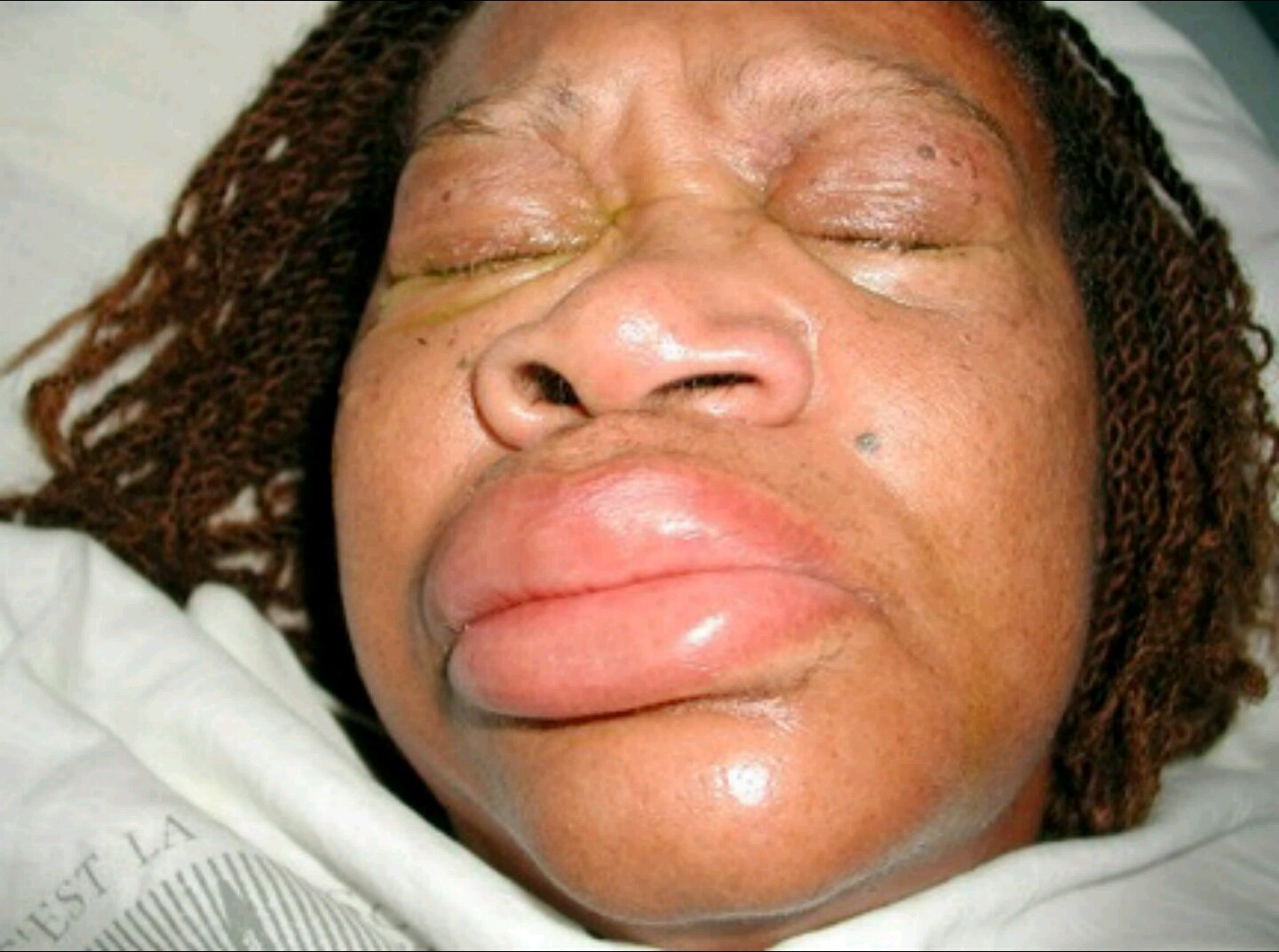 荨麻疹 越挠越痒越挠越痒の药物击破攻略 (转载)