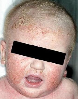 儿童身上的皮疹常见的都是什么病?