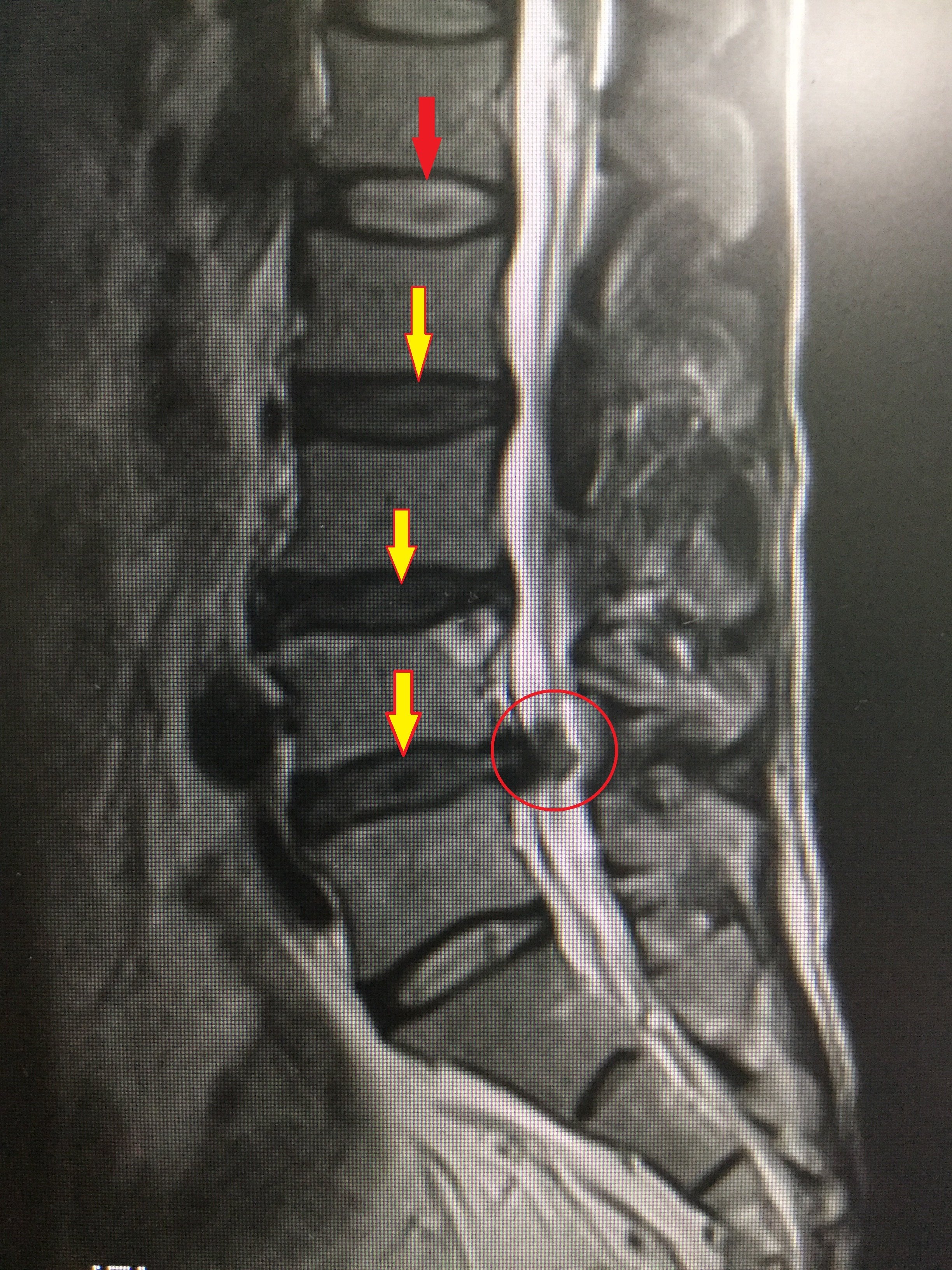 腰椎间盘突出中央型图图片