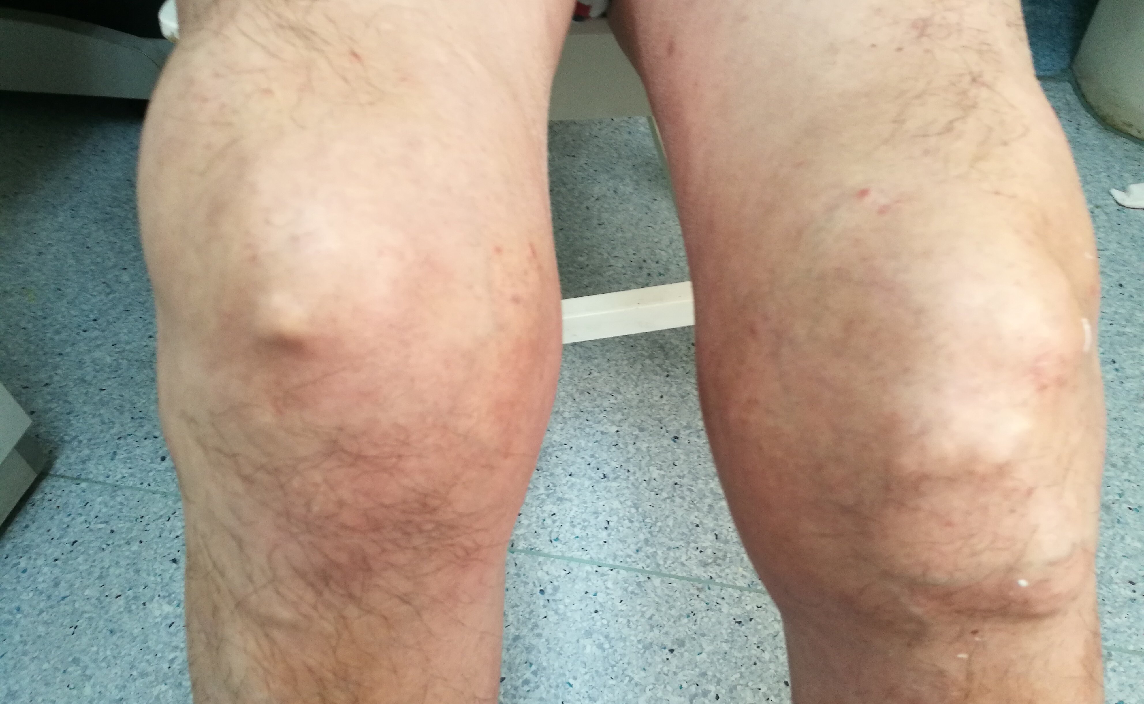 患者双膝关节已经变形,肉眼可见皮下明显的尿酸盐沉积形成的痛风石,膝