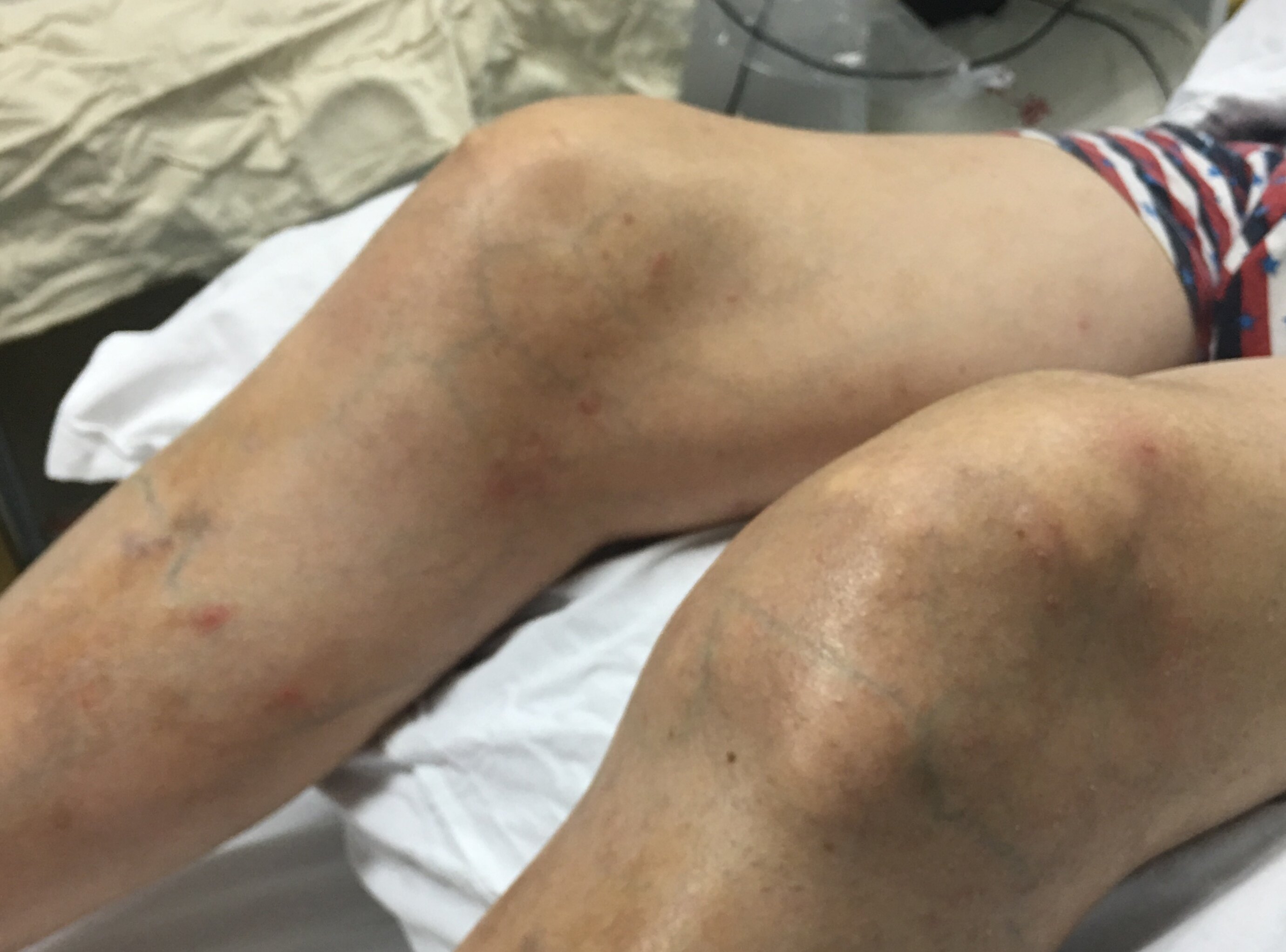 患者双膝关节已经变形,肉眼可见皮下明显的尿酸盐沉积形成的痛风石,膝