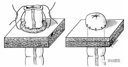 醫學小品腸造口的概念目的位置和分類一篇文章講清楚