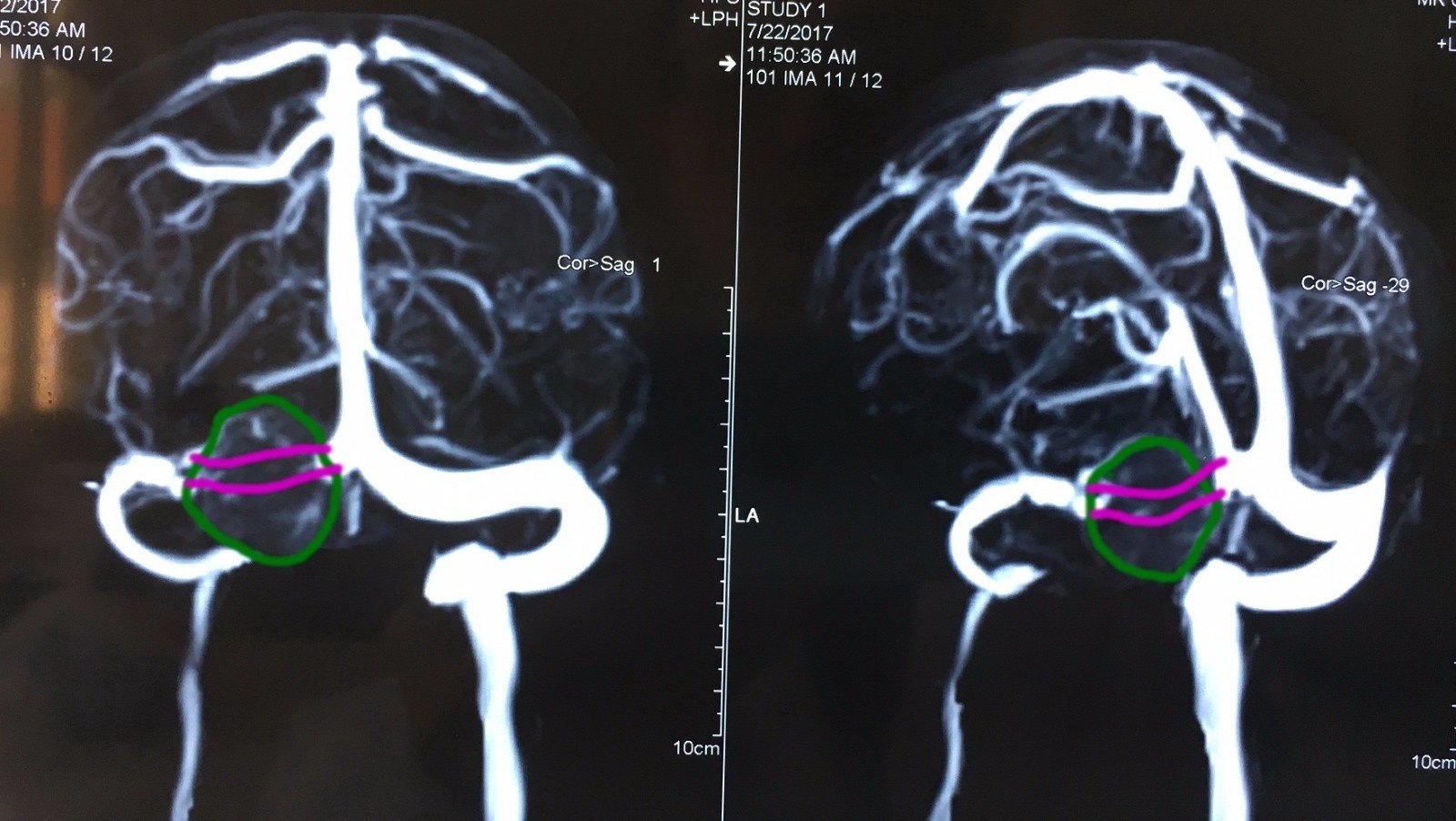 横窦-天幕脑膜瘤全切一例 - 好大夫在线