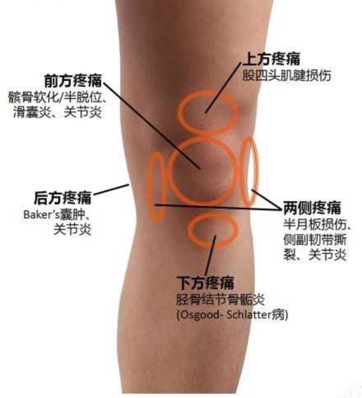 不同部位的膝关节疼痛常见的原因 不同部位的膝关节疼痛常见的原因