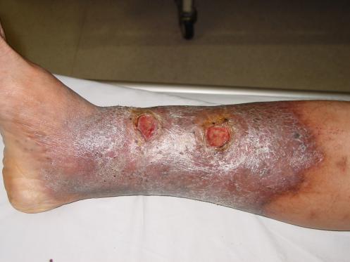 得了 老烂脚 怎么办