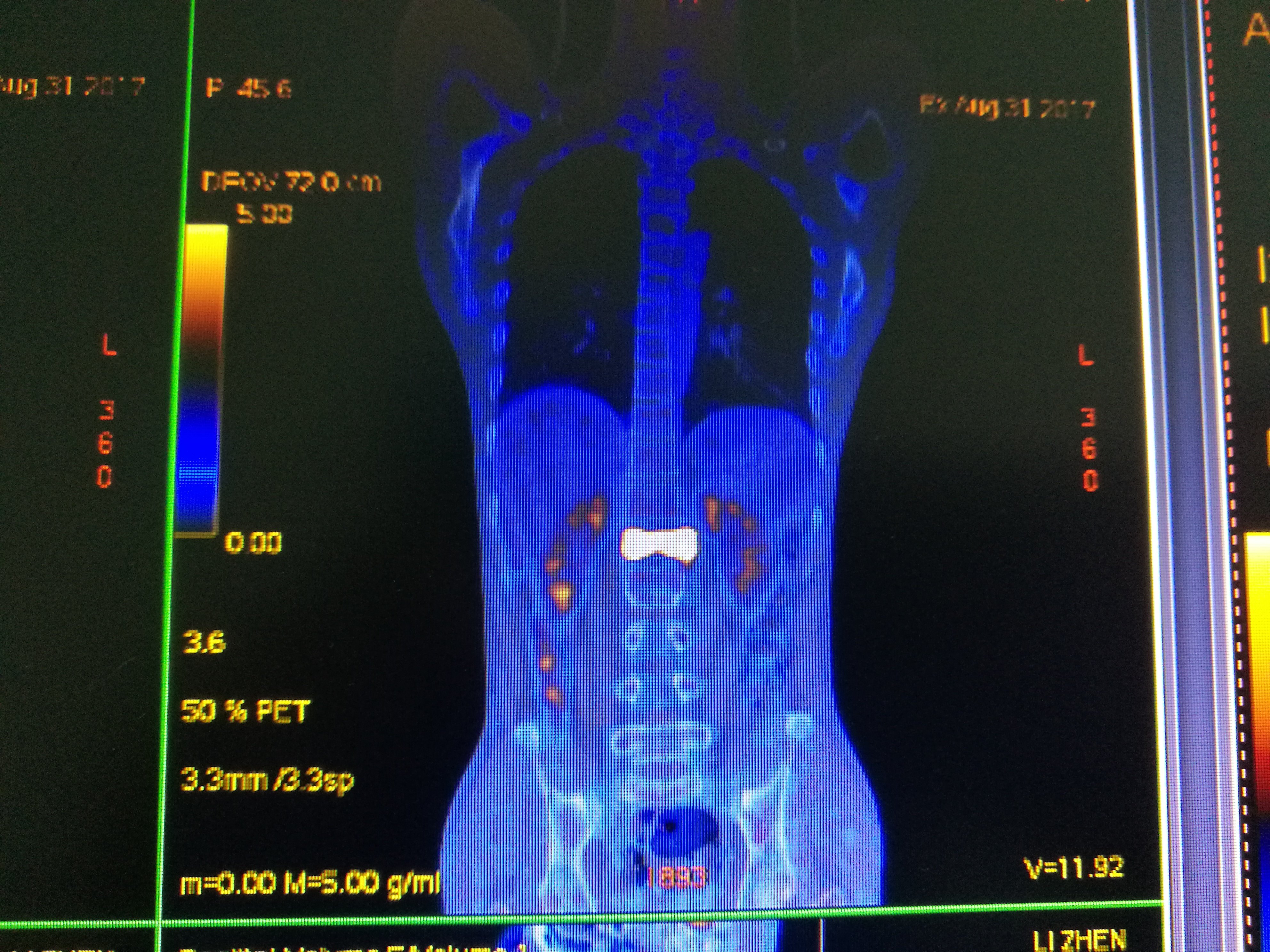 腰1椎体肿瘤(恶性),完整彻底切除 - 好大夫在线