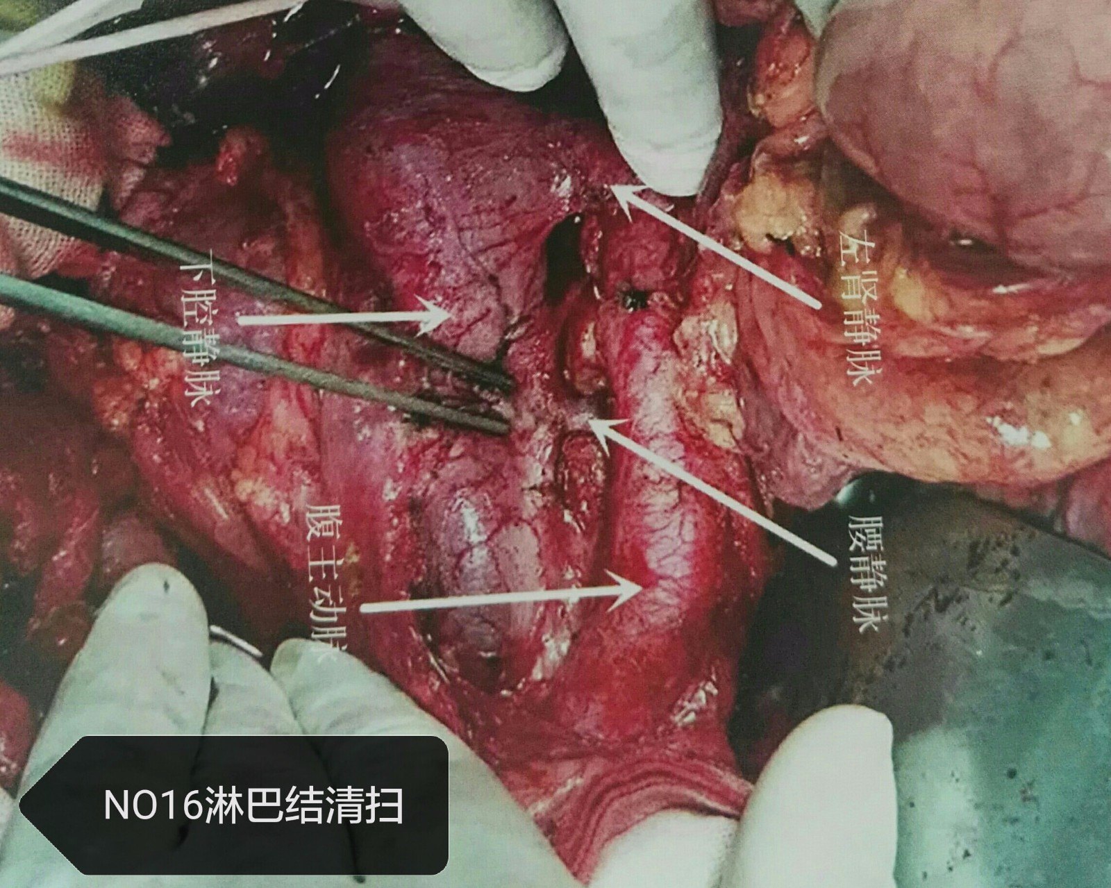 漂亮的腹主动脉周围淋巴结(no16)清扫 - 好大夫在线