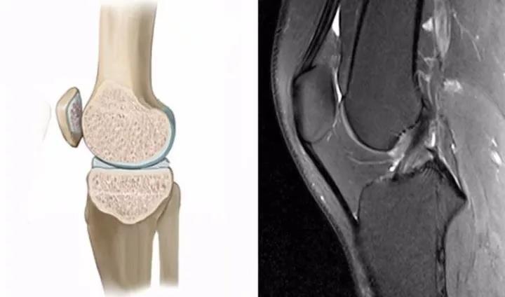 膝关节外伤 对膝关节损伤诊断极为重要的外伤性骨髓水肿