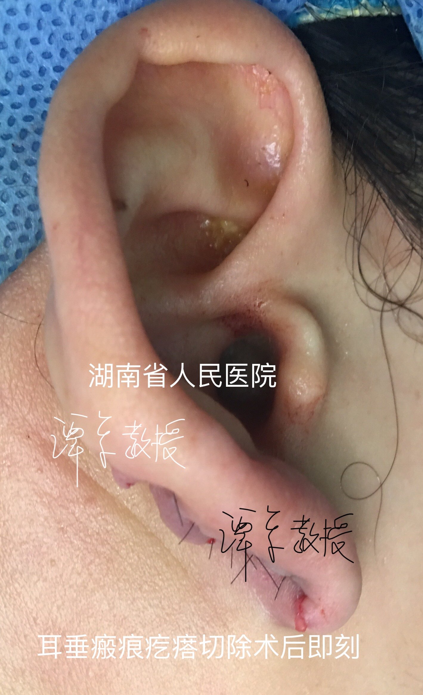 耳垂瘢痕疙瘩切除耳垂重建术