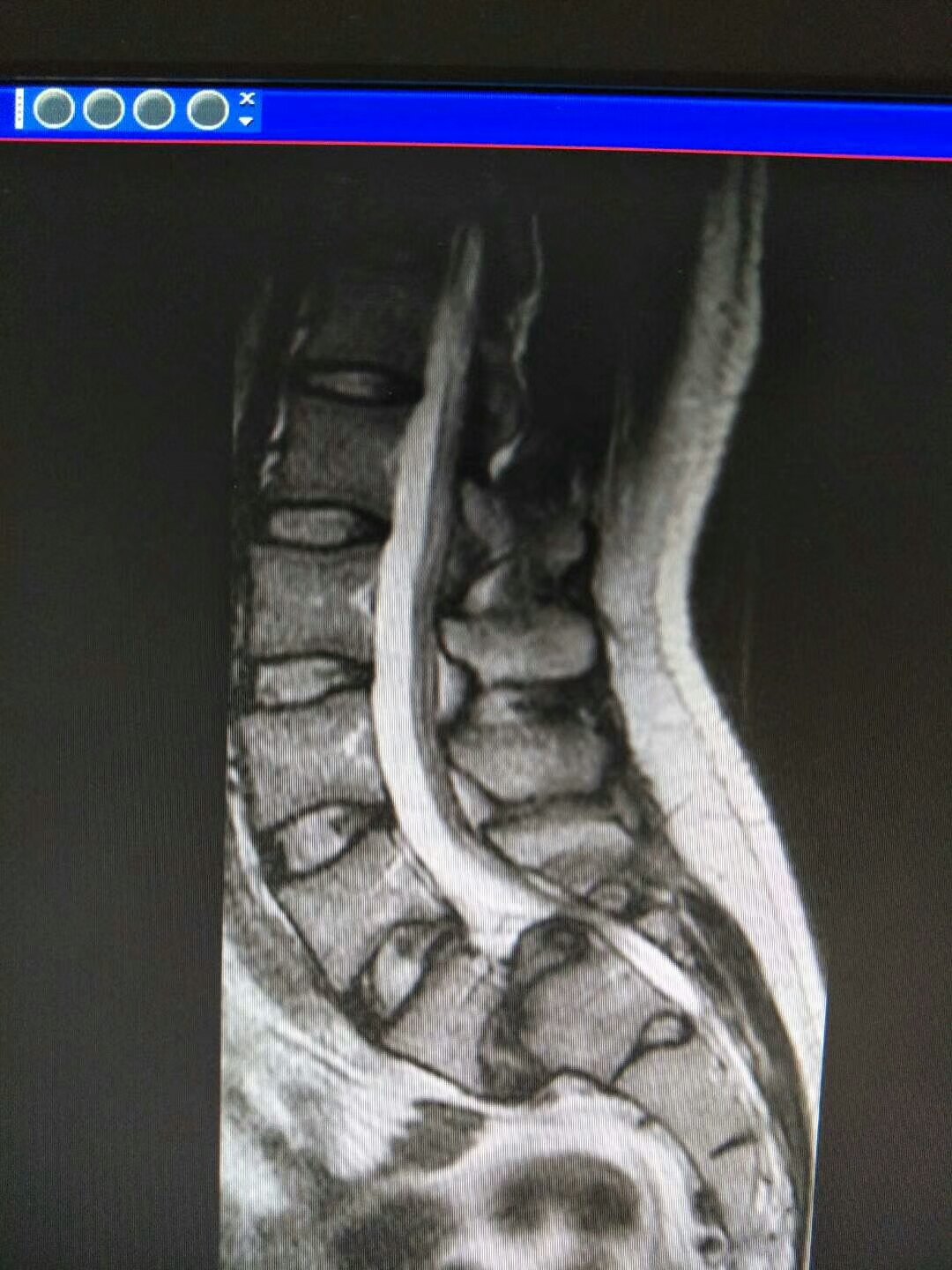 椎弓峡部裂CT图片