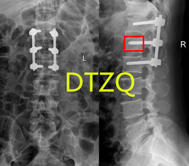 复位术后x光片:腰1椎体复位,椎体高度恢复术后第3天患者佩戴支具下地
