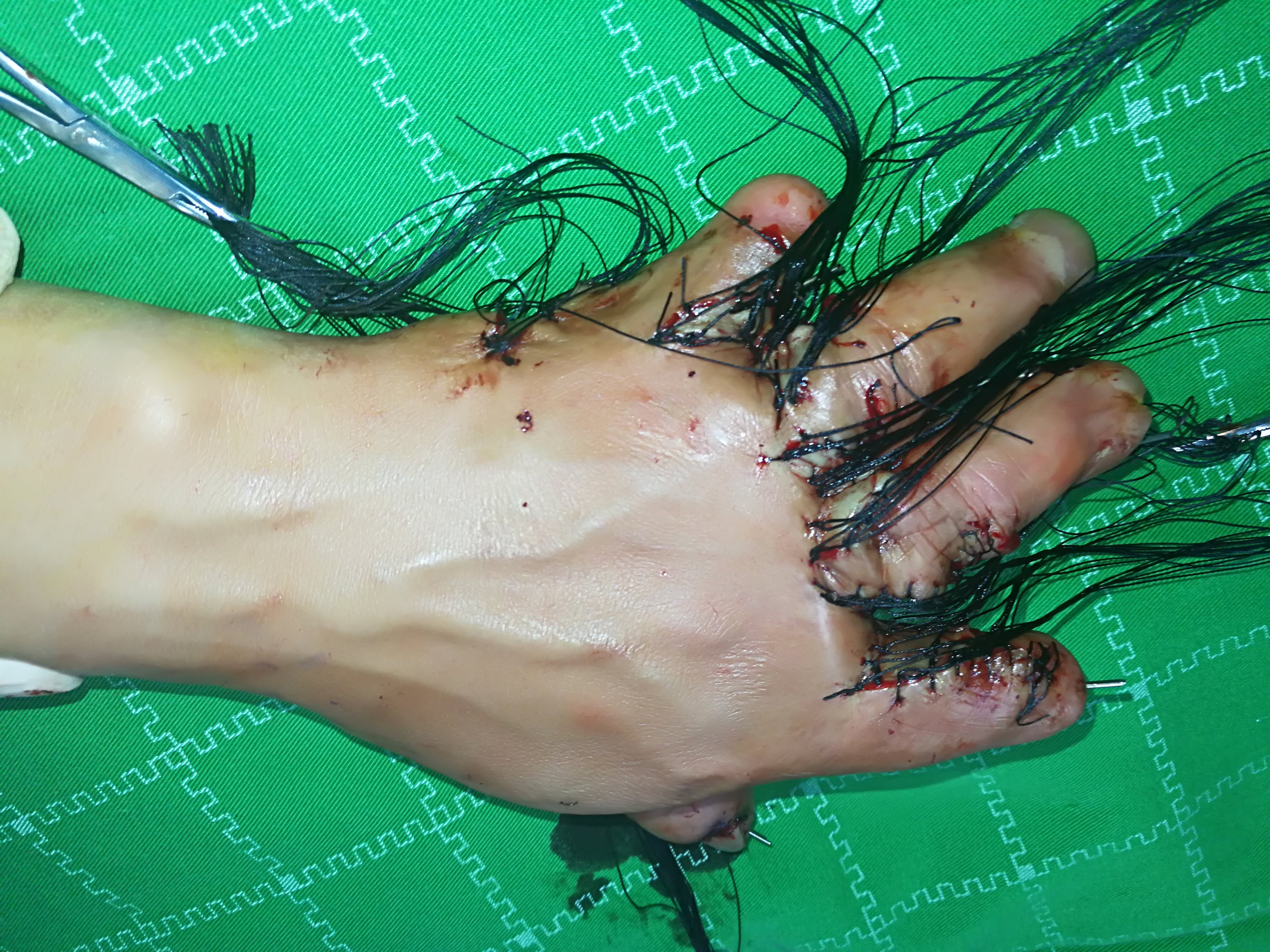 一个烧伤疤痕挛缩病例 - 好大夫在线