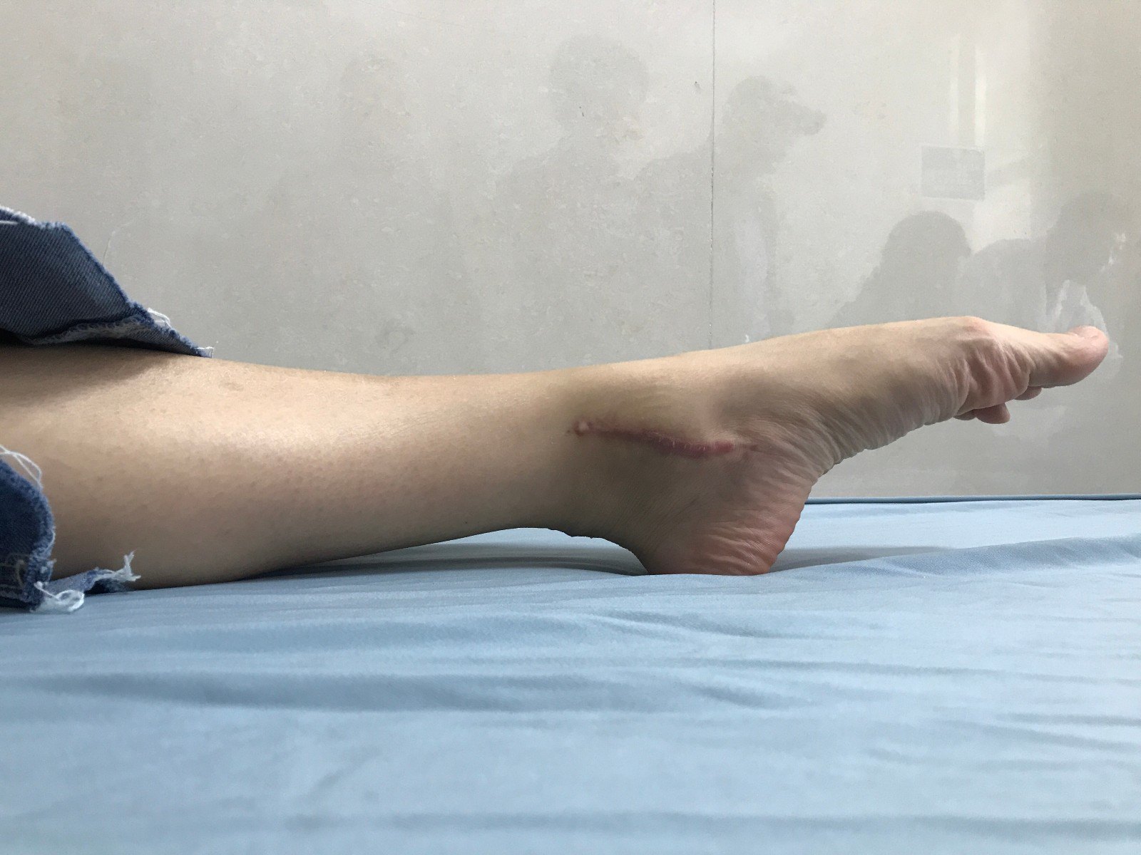 踝关节骨折l-h旋后外旋4度损伤病例分享 - 好大夫在线