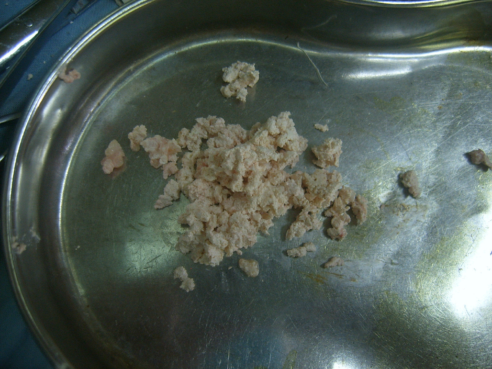 尿酸盐结石图片
