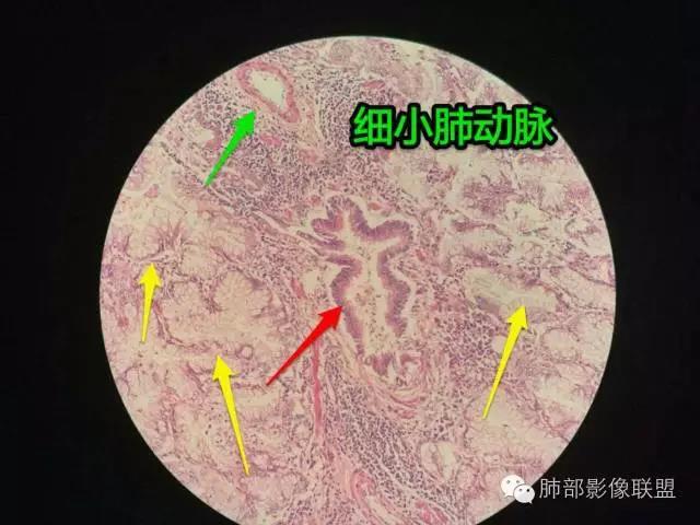 王兆宇 15:27說明在肺粘液腺癌中,支氣管與肺動靜脈的破壞不嚴重.