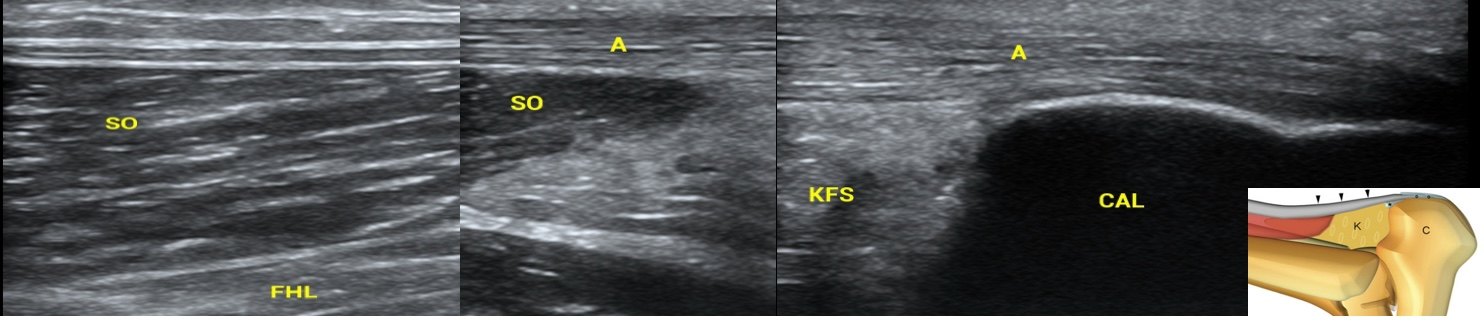 图3 跟腱超声长轴(上图),短轴(下图)超声自肌-腱结合部开始至跟骨附着