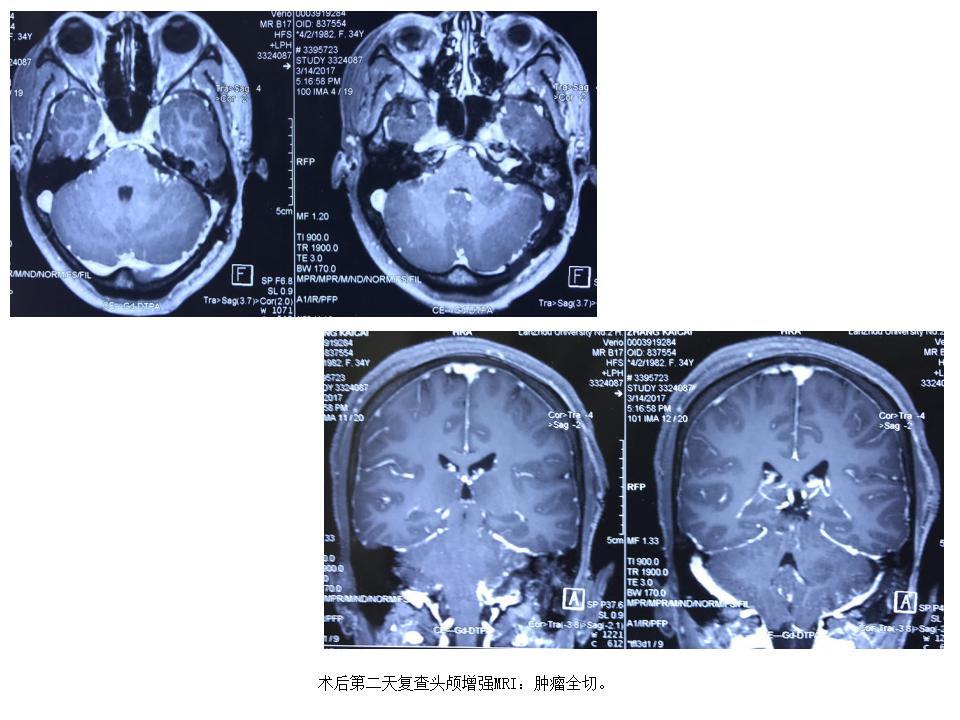 微創手術切除顱底橋小腦角區巨大腦膜瘤